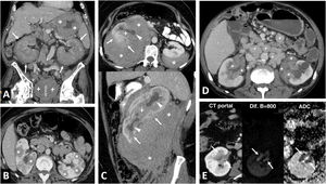 Renal lymphoma. (A) Diffuse infiltration of both kidneys (arrows), in addition to infiltration also demonstrated by a lymphoma of the prostate (+), with the stem of a bladder catheter in its urethral section, and a lymphoma of the gastric wall (*). (B) Multiple and bilateral nodules with discrete enhancement (*). (C) Perirenal solid masses (*) with discrete enhancement, which infiltrate the superficial renal parenchyma (arrows) and penetrate the renal sinus (+), causing discrete hydronephrosis (arrowheads), albeit sparing the vessels (not shown). (D) Peripelvic and renal sinus infiltration (*), in this case accompanied by abundant retroperitoneal and mesenteric lymphadenopathies (+). (E) Infiltration of the renal sinus, with significant water diffusion restriction, high signal in the diffusion sequence with B = 800 s/m2 and low signal in the apparent diffusion coefficient (ADC) map (arrows).