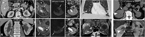 Multiple benign lesions that may mimic tumours. IgG4-related disease. (A) Lymph node involvement. Small, occasionally triangular, renal cortical nodular lesions are hypoenhancing on CT, with low T2 signal and restricted water diffusion (arrows). One contains a small cyst. Other features related to the involvement of this entity include: autoimmune pancreatitis with tumefaction, absence of superficial crypts and subtle halo around the pancreatic tail (hollow arrows), IgG4-related sclerosing cholangitis, with secondary dilatation of the intrahepatic biliary tract (arrowheads), peripheral opacities in both lung bases (arrowheads) and orbital involvement, with enhancing infiltration on MRI of the lacrimal gland (+), the extraocular musculature (*) and to a lesser extent of the orbital fat itself. All lesions responded to steroid therapy. (B) Perirenal involvement. Bilateral peripelvic infiltrative lesion mildly hyperattenuating on non-contrast CT and hypointense on T2 (arrows), with left renal hypotrophy and right calyceal dilatation (arrowheads).