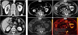 Multiple sporadic bilateral renal tumours with discordant histology. (A) Contralateral clear cell (ccRCC) and papillary carcinomas (pRCC). ccRCC on right (arrows). Lesion with significant enhancement and eccentric necrotic areas on coronal and axial CT images in corticomedullary phase. pRCC on left (hollow arrows). Lesion homogeneously hypoenhancing. Arrowheads: hepatic haemangioma. (A) Contralateral ccRCC and chromophobe carcinomas. Upper left: Baseline CT (axial image in nephrographic phase). Incidental finding of well-demarcated right lower renal nodular lesion with moderate enhancement, less than that of the adjacent renal parenchyma (arrow). A contralateral cortical lesion with more intense enhancement, very similar to that of the renal parenchyma (dashed arrow) was overlooked. A right nephrectomy was performed revealing a pT1a cRCC. A review three years later revealed this lesion, with moderate growth (not shown). Six years after the first study, spectral CT was acquired (upper right: average image; lower left: virtual non-contrast image; lower right: iodine map), which again demonstrated moderate growth during the interval and iodine density of 6.8 mg/mL. Core needle biopsy revealed a pT1a ccRCC following partial nephrectomy.