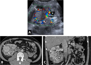 Von Hippel-Lindau syndrome. A 40-year-old male under follow-up for Von Hippel-Lindau syndrome with a genetic diagnosis and a previous left nephrectomy. In the follow-up with ultrasound and colour Doppler (A), a solid nodular lesion measuring 41 mm (arrows) is detected, confirmed by CT in the nephrographic phase (B and C) and susceptible to selective resection. Renal cysts are also visible (*).