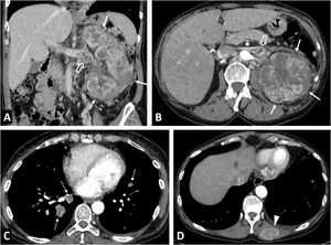 Clear cell renal cell carcinomas (ccRCC) with BAP1 somatic mutation. (A) Coronal CT in nephrographic phase. (B, C and D) Axial CT in corticomedullary phase. A 51-year-old woman with constitutional symptoms and a palpable left lumbar mass. CT shows a left renal tumour with highly infiltrative growth and heterogeneous enhancement (arrows), accompanied by a tumour thrombus in the left renal vein (hollow arrows), as well as pulmonary metastases (dashed arrows) and muscle metastases (arrowhead). Histological examination of the surgical specimen showed a histological grade 4 ccRCC with sarcomatoid features and BAP-1 somatic mutation.