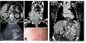 PTEN syndrome-associated clear cell renal cell carcinoma (ccRCC). (A–D) PTEN syndrome. (A) Axial CT scan of the abdomen in the nephrographic phase. (B) Transverse section of ultrasound in B-mode of right hypochondrium. (C) Coronal cervical CT. (D) Photograph of the forehead. An 81-year-old male with haematuria. Physical examination revealed macrocephaly, a mass located at the base of the right side of the cervical region and evident papillomatous facial lesions (D). Imaging studies show several focal right renal lesions with intense enhancement and areas of necrosis (arrows). The largest of these is accompanied by a tumour thrombus, grade 4 in the Mayo clinic classification, which is echogenic and uptakes contrast (*). In addition, a large enhancing mass is visible near the right thyroid lobe (hollow arrows in C). A core needle biopsy was performed on the principal renal mass, which was diagnosed as ccRCC, and on the thyroid mass, which was diagnosed as follicular thyroid cancer, the most frequent histological subtype in this syndrome. The patient died before genetic testing was carried out, but they met the criteria for PTEN syndrome. (E) PTEN syndrome simulator. Coronal CT in nephrographic phase. A 79-year-old female. Lobulated renal mass with intense enhancement and central necrosis (arrows) together with a similar mass near the left thyroid lobe. While PTEN syndrome was suspected, the histological diagnosis was ccRCC with thyroid metastasis. The patient did not meet any other clinical criteria for PTEN.