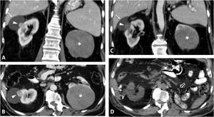 Hereditary papillary renal cell carcinoma (pRCC) in a 74-year-old male. Incidental finding. (A) (coronal) and (B) (axial; composite image). CT in nephrographic phase. Exophytic right renal cystic mass (arrows) with a solid nodule hypoattenuating with respect to the renal parenchyma (arrowheads). There is also an exophytic cortical mass, which is also hypoattenuating, near the contralateral kidney (*). A core needle biopsy of the solid component of the right solid nodule was performed, revealing a pRCC, and so percutaneous radiofrequency thermoablation was performed in the same procedure. (C) Coronal CT in the nephrographic phase one day after ablation. Loss of tension in the right cystic component (arrow) and small residual attenuating image (arrowhead), without enhancement compared to the non-contrast study (not shown). The contralateral lesion (*) showed absolute enhancement of 32 HU and was also suspected to be a pRCC. The urology department decided to perform a left nephrectomy, which confirmed this suspicion. In addition, numerous millimetric papillary adenomas were identified in the left kidney. (D) Axial CT (composite image) without contrast (due to renal failure) five years after nephrectomy. Image showing no recurrence in the right kidney (dashed arrow) and left nephrectomy (hollow arrow).