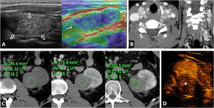 Papillary thyroid carcinoma and papillary renal neoplasia in a 32-year-old female. Palpable enlarged lymph nodes in the neck. (A) B-mode ultrasound of the left thyroid lobe and qualitative strain elastography of the cervical lymph node. (B) Cervical CT (axial and coronal) with intravenous contrast. Hypoattenuating nodular lesion measuring 21 mm with microcalcifications in the left thyroid lobe (hollow arrows) and laterocervical lymphadenopathies, also with microcalcifications and tissue stiffness on qualitative elastography. The histological result after surgical resection was papillary carcinoma with lymph node metastases. (C) CT at the level of the left kidney, without contrast, in the corticomedullary phase and in the nephrographic phase. (D) Non-contrast ultrasound. Axial image captured 55 seconds after contrast administration. Exophytic cortical solid nodular lesion in the left kidney that was slightly hyperattenuating in the baseline study, and discreet enhancement that even raised the possibility of pseudoenhancement on CT (ROI), better seen on contrast-enhanced ultrasound (*), where intralesional ‘bubbles’ could be observed in real time. A partial nephrectomy was performed, which resulted in a diagnosis of papillary renal cell carcinoma. There was no familial aggregation, and no genetic testing was carried out.