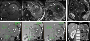 Hereditary leiomyomatosis and renal cell carcinoma. A 26-year-old female with constitutional symptoms, pain and a palpable mass in the left lumbar region. (A) MRI. Axial images with T1-weighted, T2-weighted, and parametric map of apparent diffusion coefficient. (B) Coronal non-contrast CT, nephrographic phase and excretory phase. Infiltrating mass measuring 135 mm in the left kidney (arrows). There are extensive cystic-necrotic and haemorrhagic areas (*), the latter with high T1 signal and water diffusion restriction, as well as papillary projections with subtle enhancement on CT, with an increase of between 23 and 31 HU in the nephrographic phase (arrowheads). It is accompanied by a tumour thrombus in the left renal vein, with similar characteristics. (C) Sagittal T2-weighted pelvic MRI performed three years earlier. Uterus with multiple hypointense fibroids (m). (D) Coronal CT image in the nephrographic phase one year after nephrectomy. Recurrence in the form of a heterogeneous mass in the surgical site (r) and liver metastases (dashed arrows). The nephrectomy specimen was initially diagnosed as papillary renal cell carcinoma type 2. Later, loss of FH staining was observed in a controlled immunohistochemical study, allowing for the diagnosis of this specific entity.