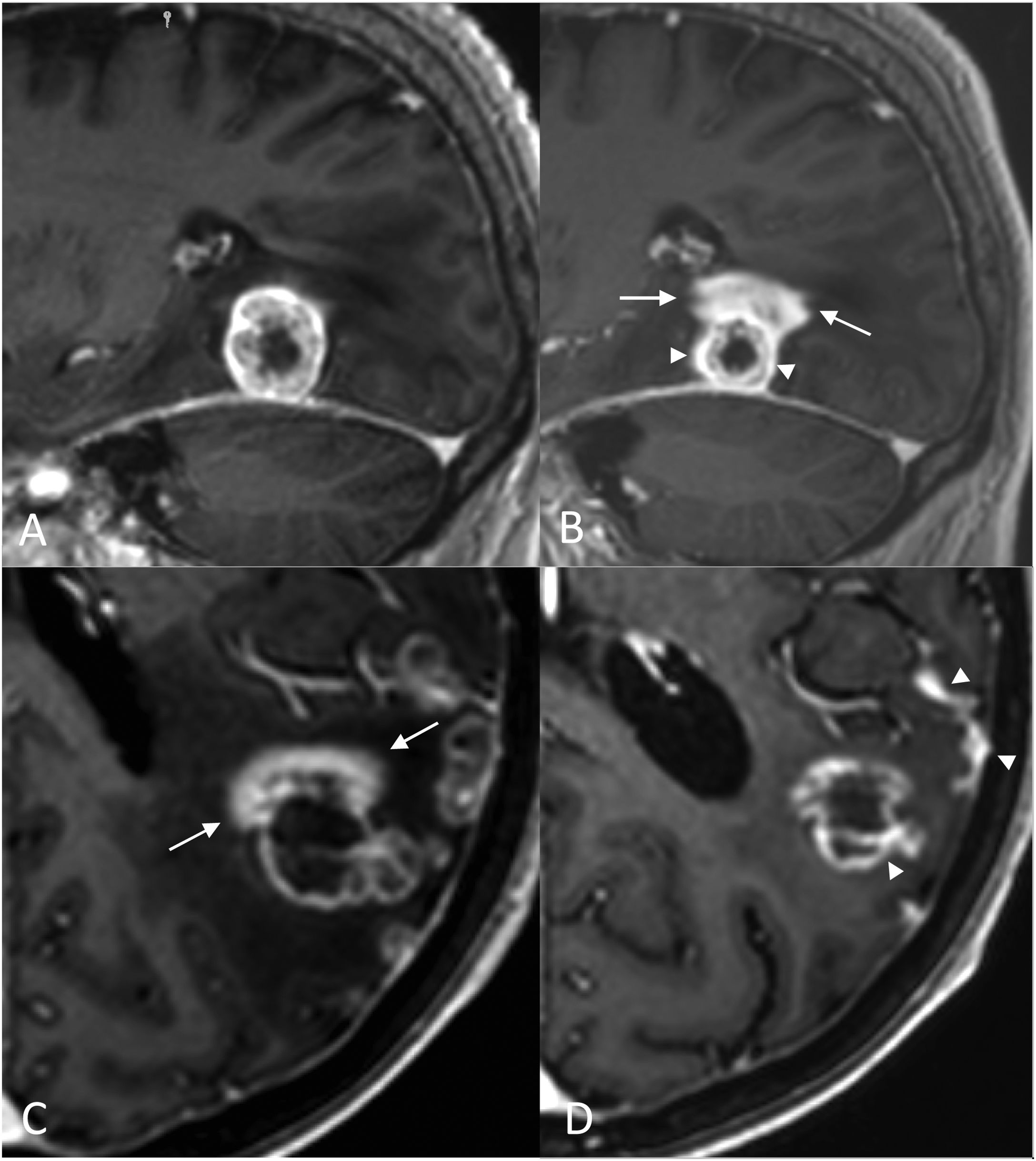 challenges-in-radiological-evaluation-of-brain-metastases-beyond