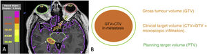 Radiotherapy planning image for a metastasis in the right hippocampus (coloured orange and marked with arrow) (A). Organs at risk are delineated including the eyeballs, chiasm, optic nerves and midbrain. The gross tumour volume (GTV) shown in orange is the volume of the metastasis that we can delineate on the MRI. In metastases, the GTV is equal to the clinical target volume (CTV), as there is no peritumoural infiltration. The planning target volume (PTV) may add a margin of 0 mm for radiosurgery or a minimum of 1 mm (green halo) for fractionated treatments.