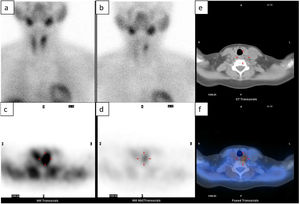 Left inferior parathyroid adenoma observed in scintigraphy. (a) 99mTc-sestaMIBI scintigraphy in early phase, (b) planar scintigraphy in late phase, (c) SPECT in early phase, (d) SPECT in phase late, (e) CT and (f) SPECT-CT. Obtained from a patient at our hospital.