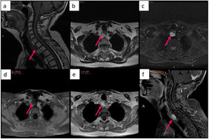 Retrotracheal parathyroid adenoma seen on MRI. (a) sagittal image of T1-weighted sequence, (b) axial image of T2-weighted sequence, (c) axial image of STIR sequence, (d) axial image of T1-weighted sequence with fat suppression and without contrast, (e) axial image of T1-weighted sequence with contrast, (f) sagittal image of T1-weighted sequence with fat suppression and contrast. Obtained from a patient at our hospital.