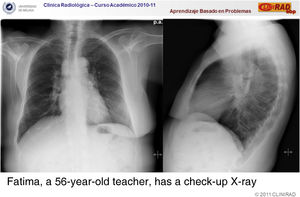 Example of one of the chest cases provided to the students in the PBL experience; AP and lateral x-rays showing right mastectomy and right paratracheal and right hilum lymphadenopathy.