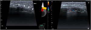 Ultrasound image of the upper quadrants of the left breast and colour Doppler. (A) A circumscribed, oval, hypoechoic solid mass, with a maximum diameter of 4 cm was identified corresponding to the fibrous capsule (arrowheads). In the anterior plane subcutaneous fat was observed (arrow). (B) The lesion demonstrates a mild Doppler colour signal uptake.