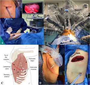 Surgical techniques: minimally invasive (A, B) and invasive (C–E). A) Video thoracoscopy showing the small incisions (see detail above left) which the thoracoscope and surgical material go through. B) Robotic surgery in which multiple incisions of less than 1 cm are made (5–7). C) Posterolateral approach through the fifth intercostal space. D) Extended posterolateral Shaw-Paulson variant (arrow). E) Anterolateral approach in which an incision is made through the fifth intercostal space below the nipple.