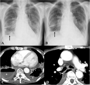 Oesophagopleural fistula. Patient underwent right lower lobectomy with infectious symptoms. A) Radiograph three days later shows an air-fluid level in the right pleural space (arrow). Two days later (B), there was a rise in the air-fluid level (arrow). Axial CT scan (C) shows an air-fluid level in both pleural spaces, with a higher level in the right hemithorax (asterisks), and enhancement of the pleural sheets. Axial CT (D) reveals communication between the oesophagus and the right pleural space (arrow), compatible with an oesophagopleural fistula.