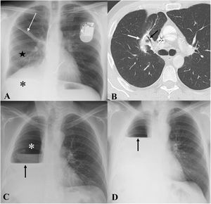 Normal findings after lobectomy and pneumonectomy. A) Chest radiograph after right upper lobectomy showing volume loss of the hemithorax with elevated hemidiaphragm (asterisk), hyperexpansion of the remaining lung (star) and laminar atelectasis adjacent to the surgical material (arrow). B) CT axial view of the same patient showing the surgical material with associated atelectasis (white arrow) and bronchial stump (black arrow). C) Radiography 24 h after right pneumonectomy showing an air-fluid cavity with more air (asterisk) than fluid (arrow). Days later (D), the gas is progressively replaced by fluid (arrow), with an expected mediastinal to ipsilateral shift.