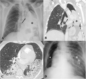 Common lung complications. A) Radiography and B) Coronal CT scan of the chest after left lower lobectomy showing complete upper lobe atelectasis (asterisk) due to mucus impaction (arrows). C) Axial CT in a patient with a wedge resection of the left upper lobe (not shown), showing consolidations in both lower lobes compatible with bronchoaspiration pneumonia (asterisks). D) Chest radiograph 24 h after right pneumonectomy (star) showing signs of acute pulmonary oedema in the left lung (asterisk).