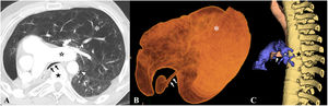 Post-pneumonectomy syndrome. Patient with right pneumonectomy who years later presented with dyspnoea and stridor. A) Axial CT, B,C) 3D reconstructions. The left main bronchus (black arrows in A, white in B and C) is stretched and compressed against the left main pulmonary artery (white star in A and C), against the descending aorta (arrowhead in A) and against the spine (black star in A and C). Note the marked hyperinflation of the left lung (asterisk in A and B).