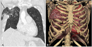 Lung hernia. Patient operated on for right upper lobectomy. A) Coronal CT scan showing protrusion of lung tissue into the intercostal space that the thoracoscope went through (arrow), with signs of vascular congestion. B) 3D volumetric reconstruction identifying pulmonary herniation through the intercostal space (arrow).