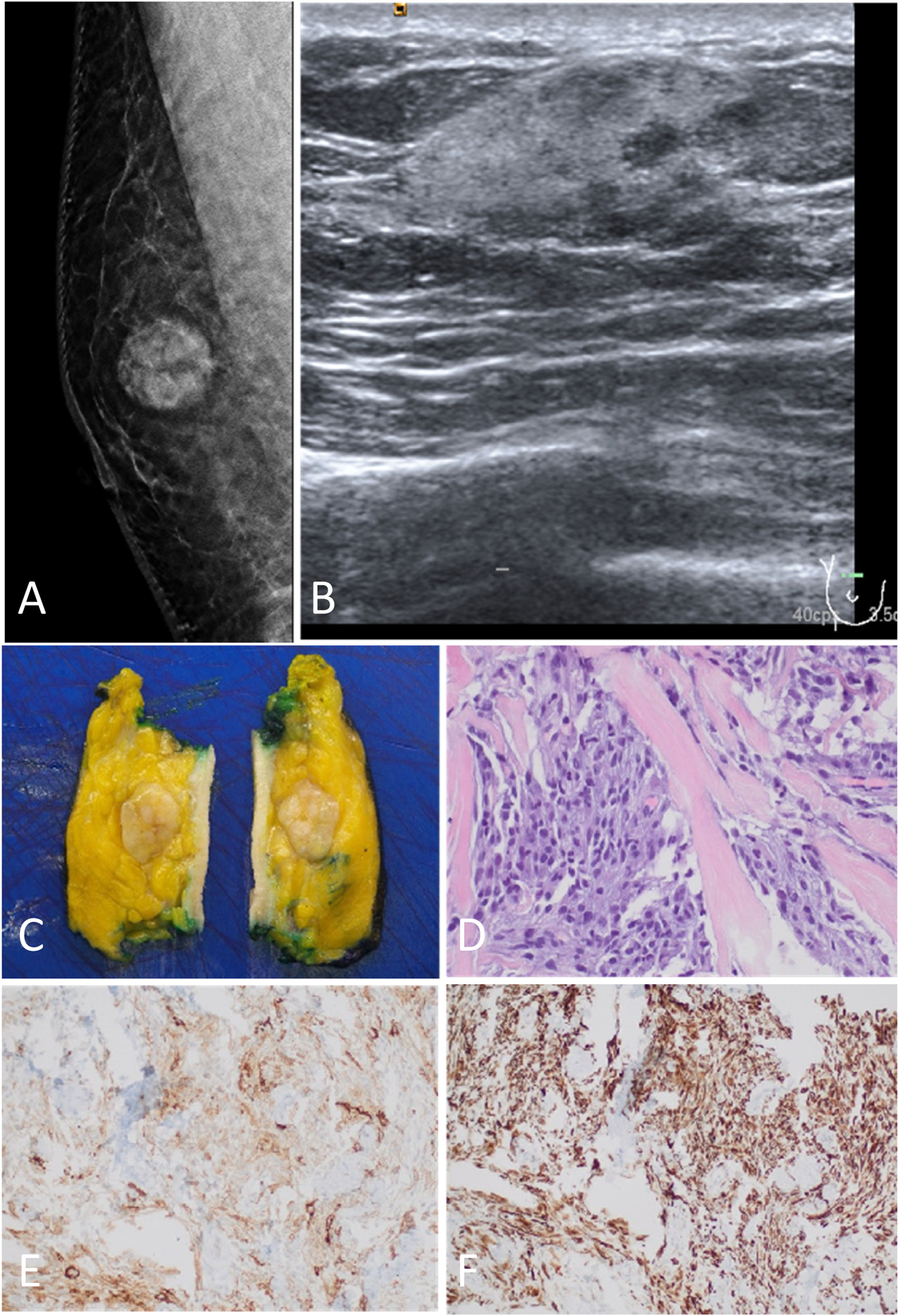 Myofibroblastoma of the breast: 3 case reports and review of literature ...