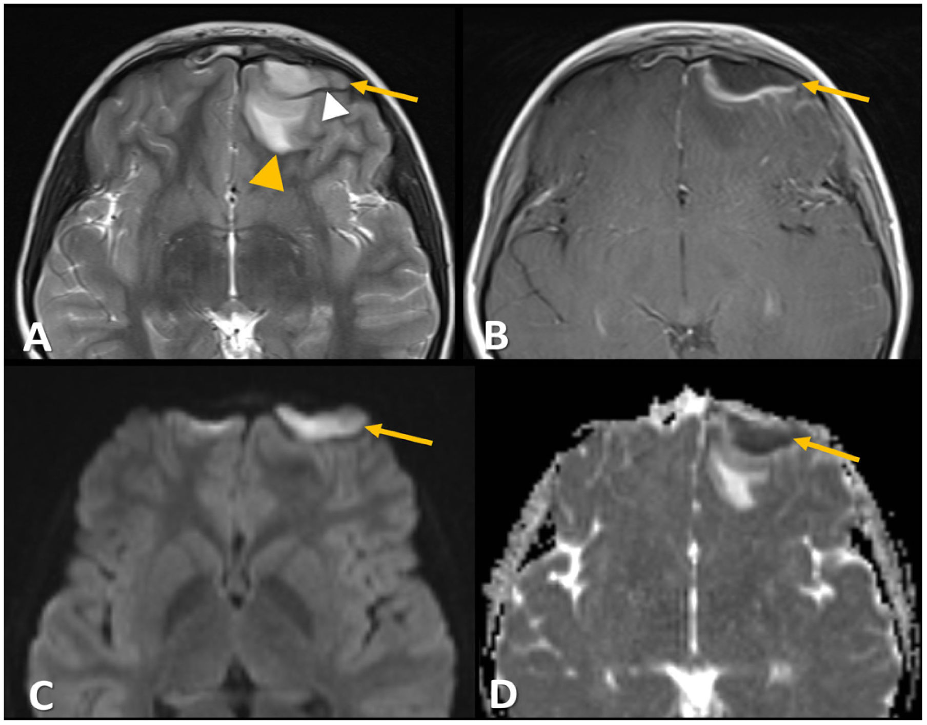 Complications of acute rhinossinusitis. A clinical radiological review ...