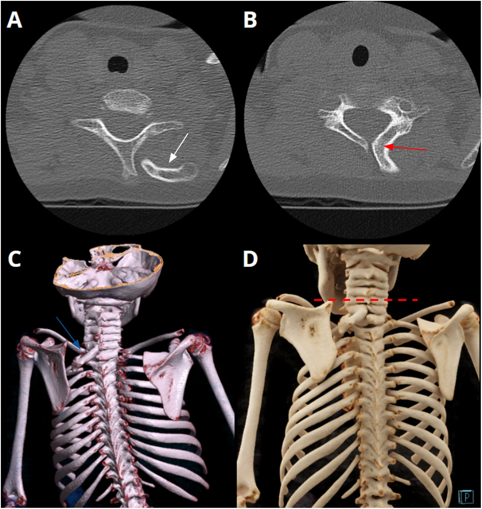Spangles Defect Sprengel’s deformity: Two illustrative cases in paediatric patients ...