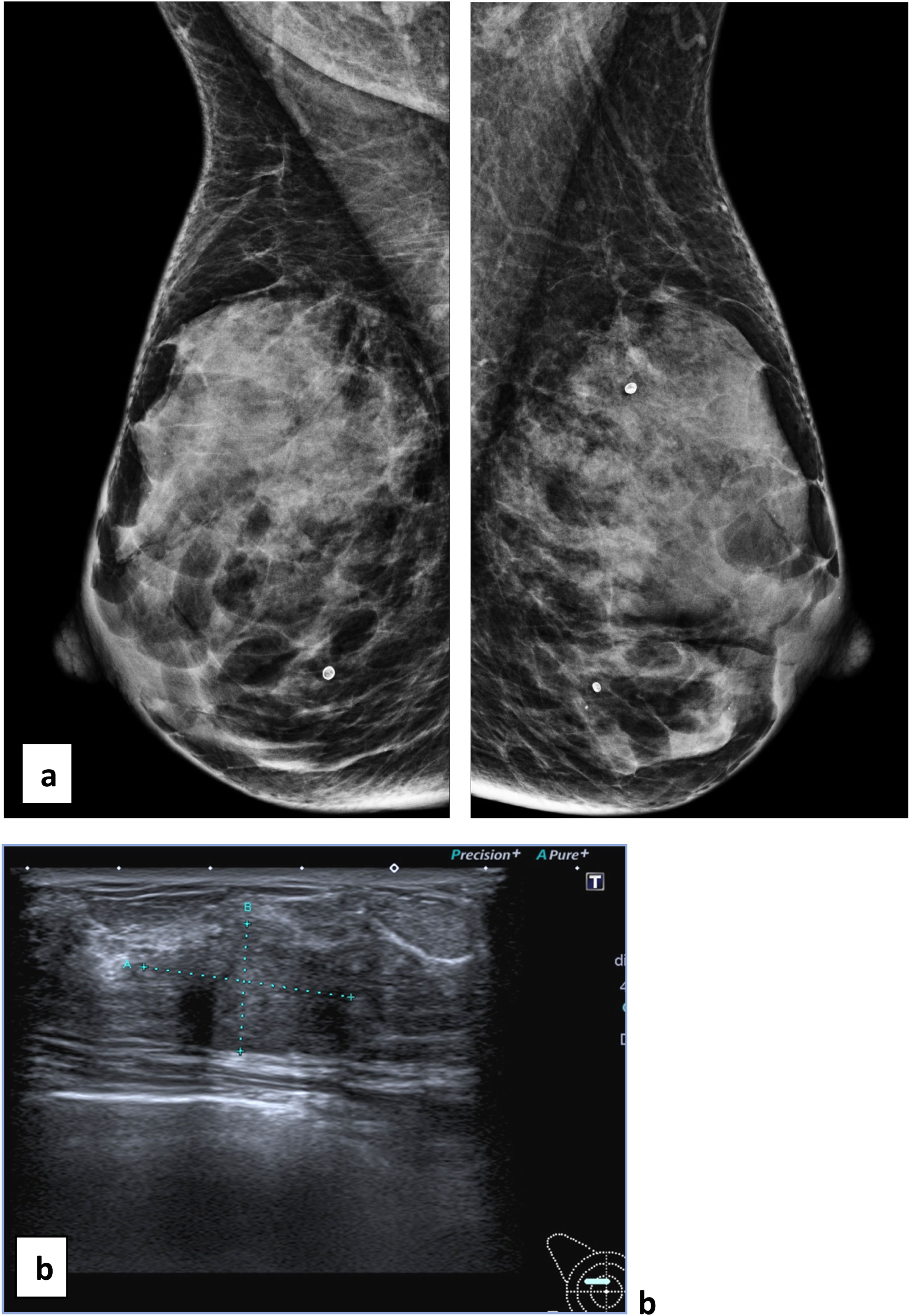 Interval carcinomas in a breast cancer screening program (2007–2018 ...