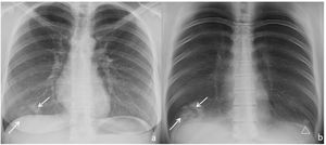 Chest radiograph (a) and digital tomosynthesis (DTS) (b) in a patient with the target sign (white arrows) visible on both the chest radiograph and the DTS. Ill-defined opacities, patchy, peripheral, ground-glass (arrowhead) due to COVID-19 pneumonia.
