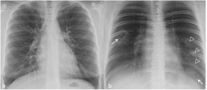 Chest radiograph (a) and digital tomosynthesis (DTS) (b) in a patient with the target sign (white arrows) visible only on DTS. Ground-glass opacities also visible in the left part of the lung (arrow heads in b) due to COVID-19 pneumonia.
