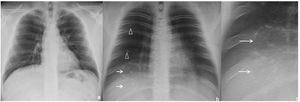 Chest radiograph (a) and digital tomosynthesis (DTS) (b and c) in a patient with target sign (white arrows) visible only on DTS. Two adjacent TS observed with joined peripheral ring opacities (b and c). Ill-defined opacities, patchy, peripheral, ground-glass (arrowheads) due to COVID-19 pneumonia.
