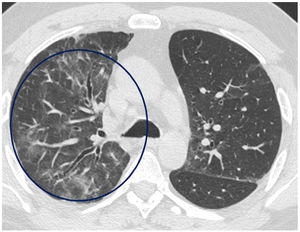 Axial image of HRCT (lung window) in a patient 18 months after a SARS-CoV-2-induced pneumonia that shows patches of ground-glass opacities in the right upper lobe (circle), as well as mild dilatation of some central bronchial structures.