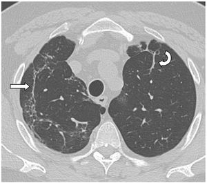 Axial image of HRCT (lung window) in a patient 18 months after SARS-CoV-2-induced pneumonia where subpleural curvilinear lines persist parallel to the thoracic wall in the right upper lobe (straight arrow), as well as parenchymal bands in the left upper lobe (curved arrow).