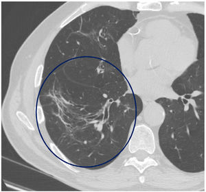 Axial image of HRCT (lung window) centred on the right lower lobe that shows architectural distortion characterised by abnormal displacement of vessels and bronchioles due to adjacent parenchymal involvement (circle).