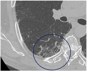 Axial image of HRCT (lung window) centred on the right lower lobe where some subpleural air-filled cysts can be seen (circle), interpreted as honeycombing by both observers.