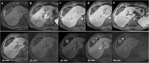 62-year-old patient with collection detected on ultrasound after cholecystectomy. Dynamic liver study with Gd-EOB-DPTA. Top row: (a) without contrast; (b) arterial phase; (c) portal phase; (d) late phase; (e) transition phase. Bottom row: sequential uptakes during the hepatobiliary phase and additional uptakes that allow the identification of extravasation of the contrast material (arrows) towards the collection in the images at minutes 26, 30 and 40.