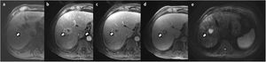 Intrahepatic cholangiocarcinoma in a patient with liver cirrhosis. Liver MRI with Gd-BOPTA (a), without contrast; (b) arterial phase; (c) portal phase; (d) hepatobiliary phase; (e) diffusion with b = 800) showed a lesion with arterial ring enhancement (b) that persisted during the portal phase (c). In the hepatobiliary phase (d), note the hypointensity of most of the lesion with a hyperintense central zone, probably due to contrast retention in the extracellular matrix. Restricted diffusion can also be seen (e). The lesion was biopsied and the diagnosis of intrahepatic cholangiocarcinoma was confirmed.