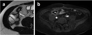 Axial plane MRE images, very useful for detecting penetrating disease and extraintestinal abnormalities. a) T2-weighted SSFP sequence showing an ileocolic fistula (arrow). b) 3D T1-weighted sequence with IV contrast. A hypointense mesenteric collection can be seen with peripheral enhancement (asterisk) compatible with an abscess.