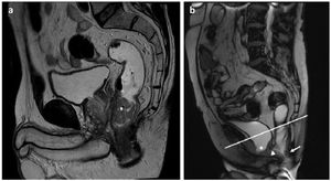 Pelvic MRI images with T2-weighted sequences in the sagittal plane after rectal administration of ultrasound gel (biphasic contrast). a) Cancer of the lower rectum (asterisk). b) Weakness of the pelvic floor with cystocele (asterisk), peritoneocele (arrowhead) and rectocele (arrow). PCL: pubococcygeal line.