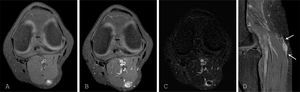 Use of non-GBCA-enhanced sequence. A) T1-weighted transverse image with spectral fat suppression. A soft tissue lesion is seen in the posterior region of the knee, with a hyperintense centre. B) T1-weighted image with spectral fat suppression after GBCA administration. C) Synthetic image obtained by subtraction (B − A), identifying peripheral contrast uptake, without enhancement in the centre of the lesion. D) Sagittal T1-weighted image after GBCA administration. Linear contrast enhancement adjacent to the lesion (arrows). AP: schwannoma of the sural cutaneous nerve.
