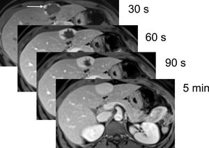 Dynamic multiphase T1-weighted gradient echo sequence with spectral fat suppression after GBCA administration. Hepatic haemangioma with nodular and peripheral contrast uptake in the initial phases of the dynamic study (white arrow), progressing towards the centre during the sequence. In the last phase, it is completely filled with contrast, being hyperintense with respect to the adjacent liver parenchyma.