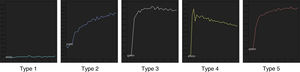 Qualitative analysis with SI/T curves. Type 1 curve: no enhancement (cysts, benign lesions). Type 2 curve: slow progressive enhancement (benign lesions). Type 3 curve: intense and early enhancement with persistent SI (indeterminate lesions). Type 4 curve: intense and early enhancement with a progressive decrease of SI (malignant lesions). Type 5 curve: intense, early and progressive enhancement (inflammatory lesions).
