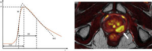 SI/T curve descriptors and parametric image. BE: brevity of enhancement; time between the point of maximum absorption and maximum disappearance; P: Peak, maximum contrast SI; TTP: time to peak; WI: wash-in or absorption rate; WO: wash-out rate. Colour-coded wash-in map, identifying a focal lesion in the left posterior-medial region of the peripheral zone of the prostate corresponding with clinically significant cancer (arrow).