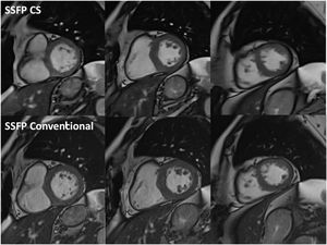 Example of cine balanced steady state free precession (SSFP) imaging with compressed sensing (CS) sequences in end-diastole (top row) in basal, mid, and apical short axis (from left to right), versus conventional SSFP counterpart images (bottom row). Notice that spatial resolution, contrast resolution and image quality of both rows are similar.