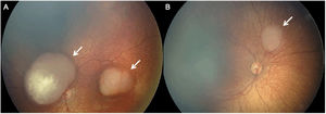 Color Fundus Photography (RetCam) image of a patient with bilateral retinoblastoma shows multiple retinoblastomas (arrows) in the right (A) and left (B) globes (arrows).