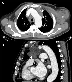 A 75-year-old man with long-standing weight loss came in with a left axillary mass. Outpatient ultrasound showed a large clump of lymphadenopathy, so a contrast-enhanced chest CT was performed. Axial maximum intensity projection (A) and sagittal (B) reconstructions confirmed the abnormal left axillary clump of lymphadenopathy (asterisk) and a mediastinal tumour mass (arrowhead) in contact with the aortic arch, with focal saccular dilation of the aorta showing some degree of parietal irregularity, suggestive of pseudoaneurysm (arrow). Histological analysis confirmed that the areas of lymphadenopathy were metastases of squamous cell carcinoma, with pulmonary origin being suspected. The decision was made to start oncological treatment with imaging to monitor response and adopt a conservative approach with the pseudoaneurysm due to the complexity of the intervention because of its location and the underlying invasive lesion.