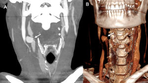 31-year-old woman who suffered an assault involving a penetrating stab wound with right submandibular entry and extensive accompanying bleeding requiring compression. Coronal maximum intensity projection (A) and 3D CT angiography reconstructions of the supra-aortic trunks in arterial phase showing a focal dilation of the right common carotid artery a few millimetres from its bifurcation, consistent with post-traumatic pseudoaneurysm.