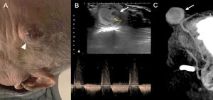 86-year-old man presenting with craniocerebral injury one month prior and since then a pulsatile mass in the left frontotemporal region of about 3 cm in diameter (arrowhead) (A). The ultrasound scan (B) shows an oval image arising from the left temporal artery with a sac with mobile internal echoes and turbulent flow consistent with a pseudoaneurysm of the left temporal artery (arrow), partially thrombosed and with bidirectional flow on spectral Doppler. The pseudoaneurysm can also be seen in the sagittal maximum intensity projection reconstruction of baseline brain CT (C).
