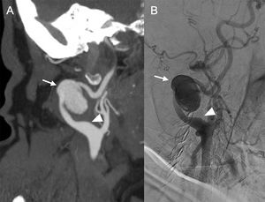 66-year-old female smoker with a history of arterial hypertension, dyslipidaemia, pulmonary embolism and deep vein thrombosis who, for months has been able to palpate a pulsatile right laterocervical mass, with no apparent cause. An ultrasound scan was performed at her health centre, detecting an aneurysmal dilation of the right internal carotid artery. Sagittal maximum intensity projection reconstruction of supra-aortic trunk CT angiography in arterial phase (A) confirming the presence of the right internal carotid artery-dependent pseudoaneurysm (arrow), and arteriogram (B) used for endovascular treatment with stenting. Both images show vascular loops and segmental dilatations (arrowhead) involving bilateral vertebral and carotid territories, which in this patient had not been attributed to any disorder until now.