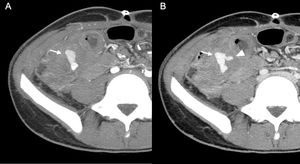 14-year-old male with abdominal pain, hypotension and rectorrhagia after recent surgery for acute appendicitis with peritonitis. Axial maximum intensity projection reconstructions of CT angiography of the abdomen and pelvis in arterial (A) and venous (B) phases showing a bilobed pseudoaneurysm (arrow) of the ileocolic artery in the surgical bed. It is accompanied by a focal area of active contrast extravasation (arrowhead) that is evident in the venous phase (B), related to bleeding due to rupture of the pseudoaneurysm.