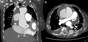 94-year-old woman admitted for congestive heart failure who, that morning, had developed chest and abdominal pain with paraesthesia in both lower limbs. Coronal (A) and axial (B) reconstructions of chest CT angiography to study pulmonary arteries for suspected pulmonary thromboembolism show a large pseudoaneurysm in the ascending thoracic aorta (arrow) and an adjacent mediastinal haematoma (arrowhead) containing the pseudoaneurysm.
