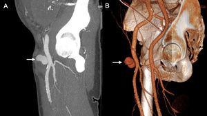 29-year-old man on peritoneal dialysis with a history of renal transplant who had embolization of the transplanted kidney one month ago, and since then developed a mass in the right inguinal region where the puncture was made. Sagittal maximum intensity projection (A) and 3D (B) CT angiography reconstructions of the right lower limb in arterial phase showing a bilobed pseudoaneurysm (arrow) arising from the right common femoral artery.