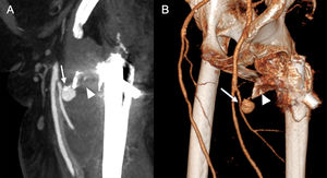 85-year-old woman who underwent surgery one month ago for fracture of the right hip. She was seen for the second time in Accident and Emergency for severe pain accompanied by induration, oedema and increased temperature in the region of the surgical wound. Sagittal maximum intensity projection (A) and 3D (B) CT angiography reconstructions of the left lower limb in arterial phase show a vascular formation arising from a perforating branch of the left deep femoral artery consistent with pseudoaneurysm. It remains in intimate contact with a displaced bone fragment that appears to be attached to the femur (arrowhead).